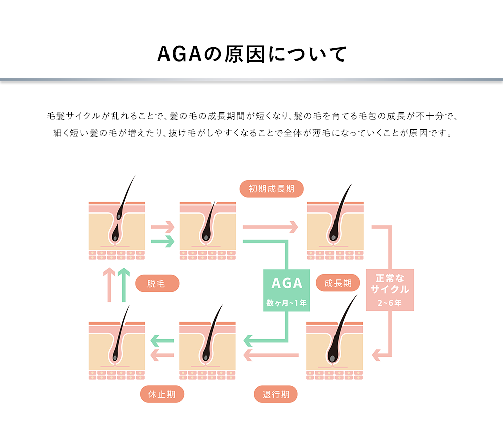 AGAの原因について