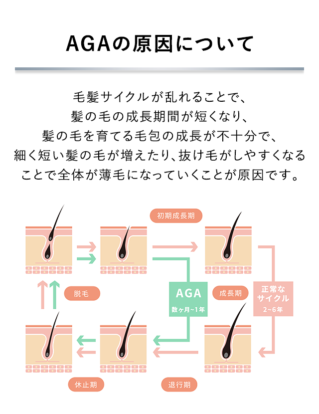 AGAの原因について