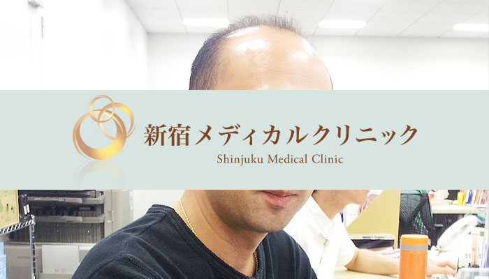 10年位前から抜け毛がひどくなって、、、。